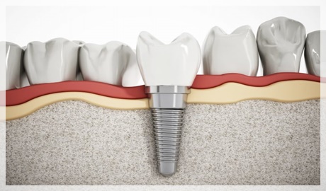 Diş implant fiyatları