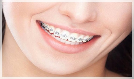 Ortodonti tedavisinde yaş sınırı var mı?