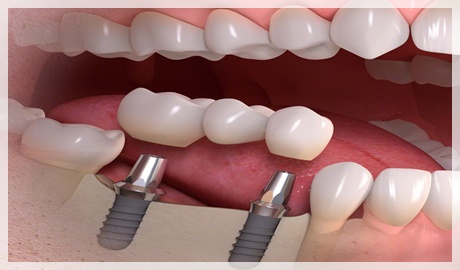 Tek diş implant fiyatı ne kadar?
